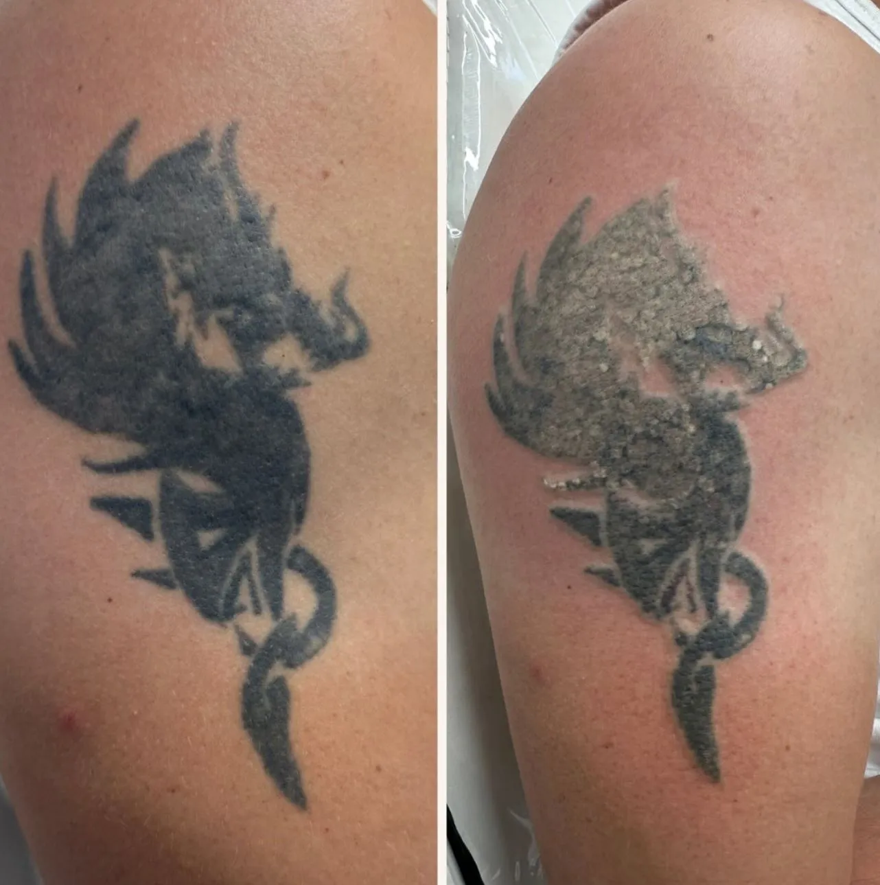 Is laser tattoo removal worth it