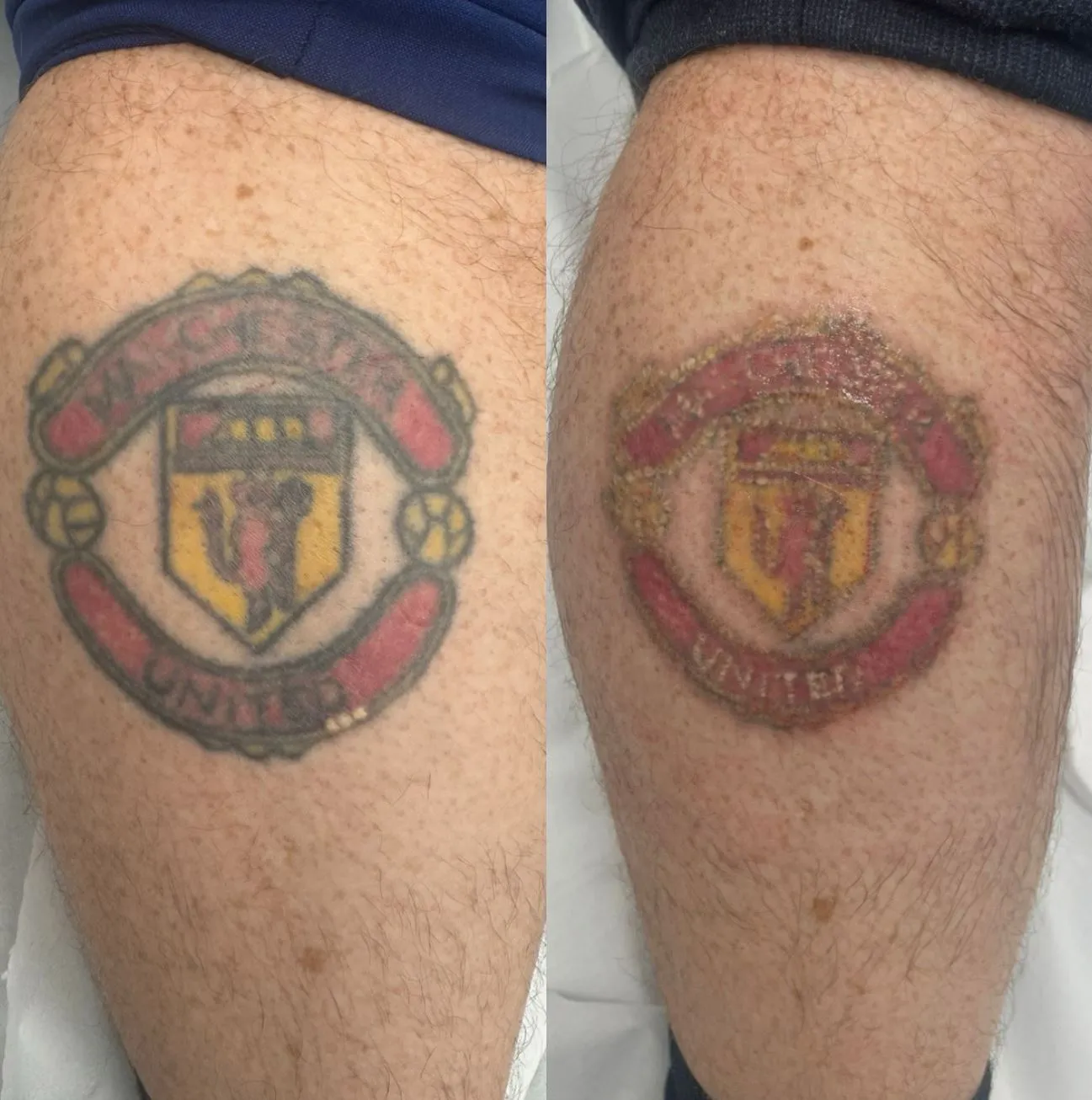 Who Shouldn’t Get Laser Tattoo Removal.