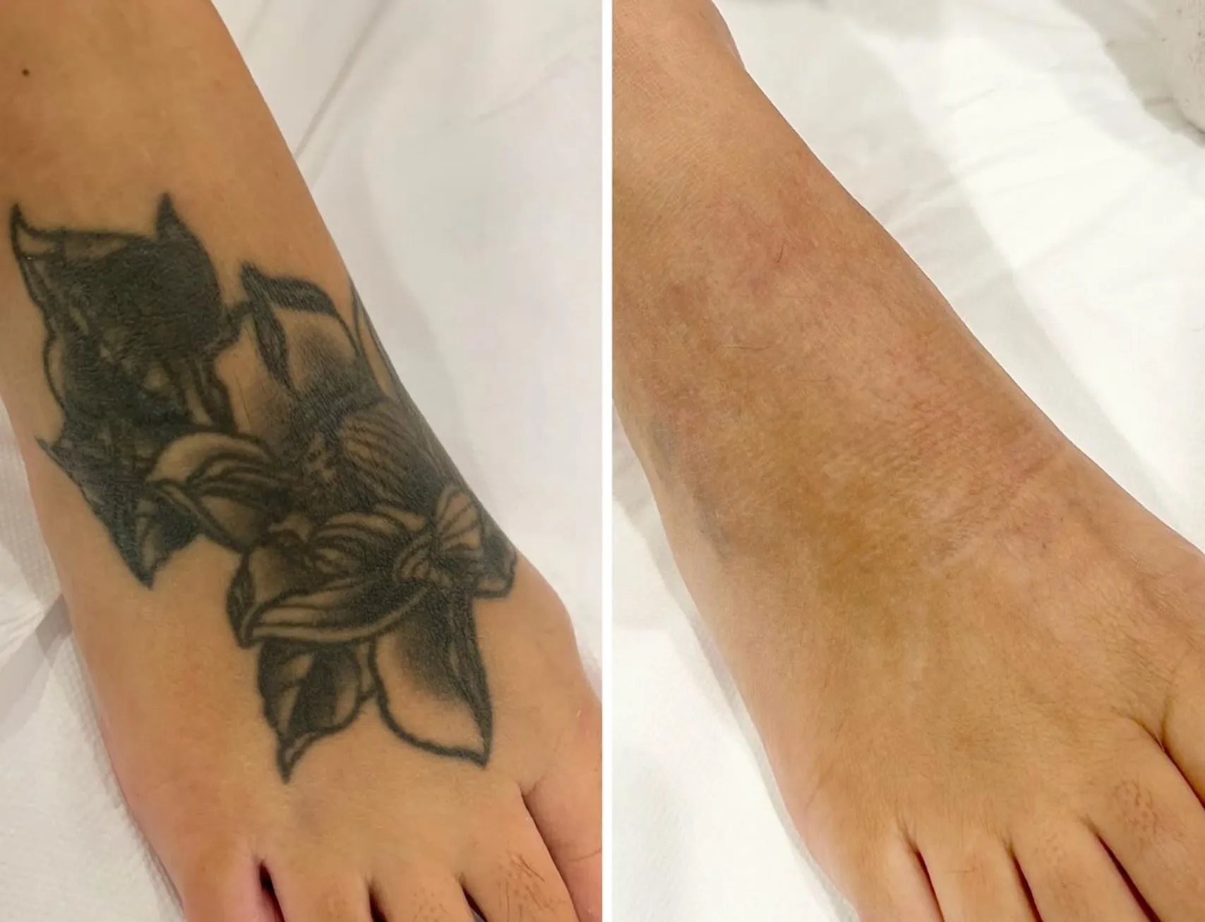Why People Remove Ink