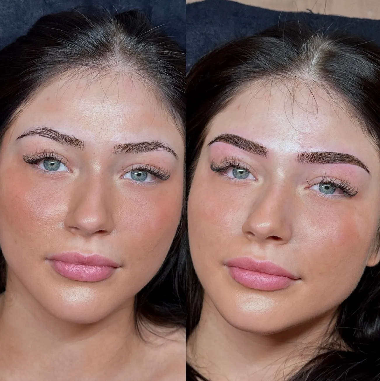 Why Skin Type Changes the Outcome